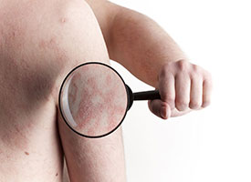 Ayurvedic Psoriasis Treatment